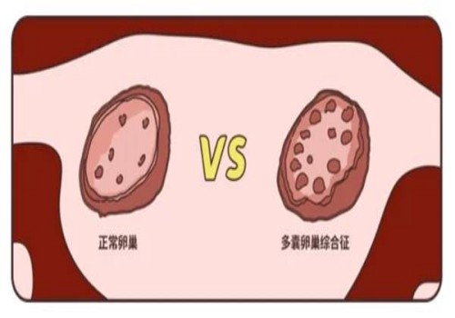 孕酮低会导致胎停或先兆流产，文章教您3个保胎小妙招
